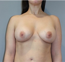 Breast Augmentation After Photo by Ellen Mahony, MD; Westport, CT - Case 48508