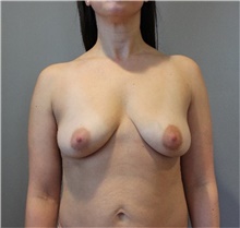 Breast Augmentation Before Photo by Ellen Mahony, MD; Westport, CT - Case 48508