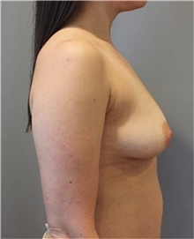 Breast Augmentation Before Photo by Ellen Mahony, MD; Westport, CT - Case 48508