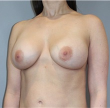 Breast Augmentation After Photo by Ellen Mahony, MD; Westport, CT - Case 48508