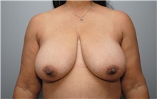 Breast Reduction Before Photo by Ellen Mahony, MD; Westport, CT - Case 48761