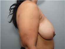 Breast Reduction Before Photo by Ellen Mahony, MD; Westport, CT - Case 48761