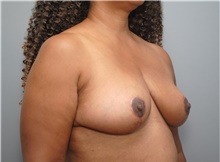 Breast Reduction After Photo by Ellen Mahony, MD; Westport, CT - Case 48761