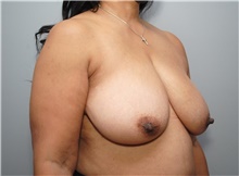 Breast Reduction Before Photo by Ellen Mahony, MD; Westport, CT - Case 48761