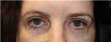 Eyelid Surgery After Photo by Ellen Mahony, MD; Westport, CT - Case 49008