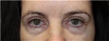 Eyelid Surgery Before Photo by Ellen Mahony, MD; Westport, CT - Case 49008