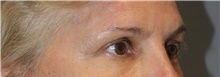 Brow Lift After Photo by Ellen Mahony, MD; Westport, CT - Case 49010