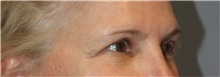 Brow Lift Before Photo by Ellen Mahony, MD; Westport, CT - Case 49010