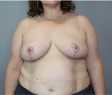 Breast Reduction After Photo by Ellen Mahony, MD; Westport, CT - Case 49011