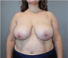 Breast Reduction Before Photo by Ellen Mahony, MD; Westport, CT - Case 49011