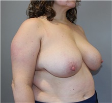 Breast Reduction Before Photo by Ellen Mahony, MD; Westport, CT - Case 49011