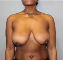 Breast Reduction Before Photo by Ellen Mahony, MD; Westport, CT - Case 49200