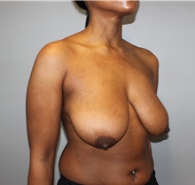 Breast Reduction Before Photo by Ellen Mahony, MD; Westport, CT - Case 49200