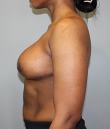 Breast Reduction After Photo by Ellen Mahony, MD; Westport, CT - Case 49200