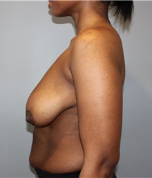 Breast Reduction Before Photo by Ellen Mahony, MD; Westport, CT - Case 49200