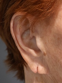 Ear Surgery Before Photo by Ellen Mahony, MD; Westport, CT - Case 50298