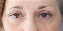 Eyelid Surgery After Photo by Ellen Mahony, MD; Westport, CT - Case 50299