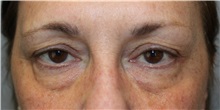 Eyelid Surgery Before Photo by Ellen Mahony, MD; Westport, CT - Case 50299