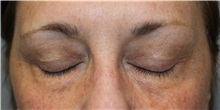 Eyelid Surgery Before Photo by Ellen Mahony, MD; Westport, CT - Case 50299