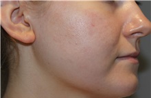 Microdermabrasion After Photo by Ellen Mahony, MD; Westport, CT - Case 50301
