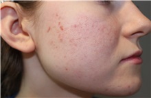 Microdermabrasion Before Photo by Ellen Mahony, MD; Westport, CT - Case 50301
