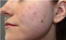 Microdermabrasion Before Photo by Ellen Mahony, MD; Westport, CT - Case 50301