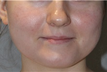 Microdermabrasion After Photo by Ellen Mahony, MD; Westport, CT - Case 50301