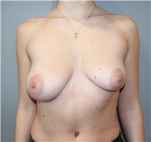 Breast Reconstruction Before Photo by Ellen Mahony, MD; Westport, CT - Case 50297