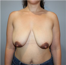 Breast Lift Before Photo by Ellen Mahony, MD; Westport, CT - Case 50313