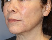 Microdermabrasion After Photo by Ellen Mahony, MD; Westport, CT - Case 50362