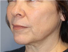 Microdermabrasion Before Photo by Ellen Mahony, MD; Westport, CT - Case 50362