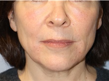 Microdermabrasion After Photo by Ellen Mahony, MD; Westport, CT - Case 50362