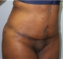 Body Lift After Photo by Ellen Mahony, MD; Westport, CT - Case 50364