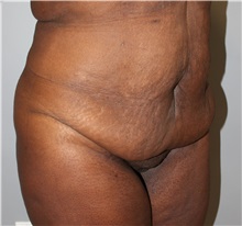 Body Lift Before Photo by Ellen Mahony, MD; Westport, CT - Case 50364