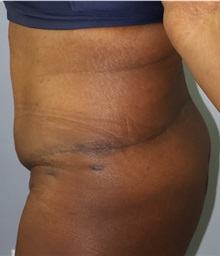 Body Lift After Photo by Ellen Mahony, MD; Westport, CT - Case 50364