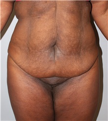 Body Lift Before Photo by Ellen Mahony, MD; Westport, CT - Case 50364