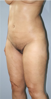 Liposuction After Photo by Ellen Mahony, MD; Westport, CT - Case 50361