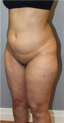 Liposuction Before Photo by Ellen Mahony, MD; Westport, CT - Case 50361