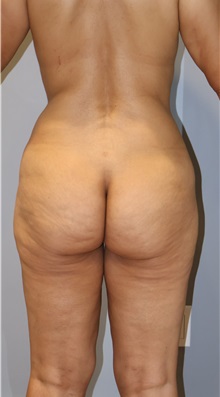 Liposuction After Photo by Ellen Mahony, MD; Westport, CT - Case 50361