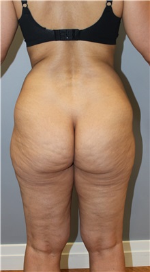 Liposuction Before Photo by Ellen Mahony, MD; Westport, CT - Case 50361