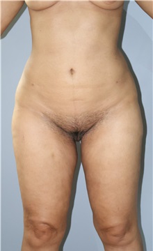 Liposuction After Photo by Ellen Mahony, MD; Westport, CT - Case 50361