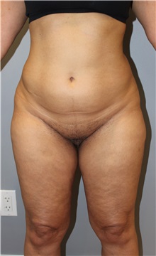 Liposuction Before Photo by Ellen Mahony, MD; Westport, CT - Case 50361