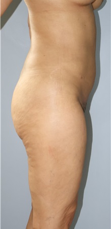 Liposuction After Photo by Ellen Mahony, MD; Westport, CT - Case 50361