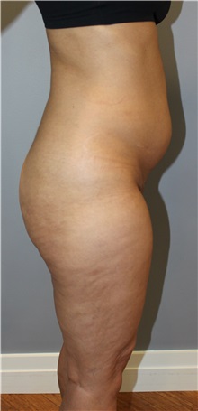 Liposuction Before Photo by Ellen Mahony, MD; Westport, CT - Case 50361