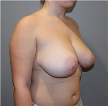 Breast Reduction Before Photo by Ellen Mahony, MD; Westport, CT - Case 50363