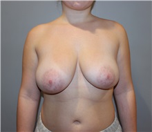 Breast Reduction Before Photo by Ellen Mahony, MD; Westport, CT - Case 50363