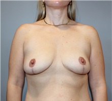 Breast Lift After Photo by Ellen Mahony, MD; Westport, CT - Case 50456