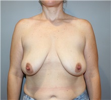Breast Lift Before Photo by Ellen Mahony, MD; Westport, CT - Case 50456