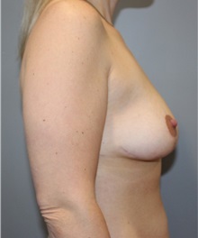 Breast Lift After Photo by Ellen Mahony, MD; Westport, CT - Case 50456