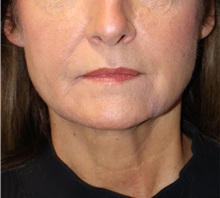 Liposuction After Photo by Ellen Mahony, MD; Westport, CT - Case 50462